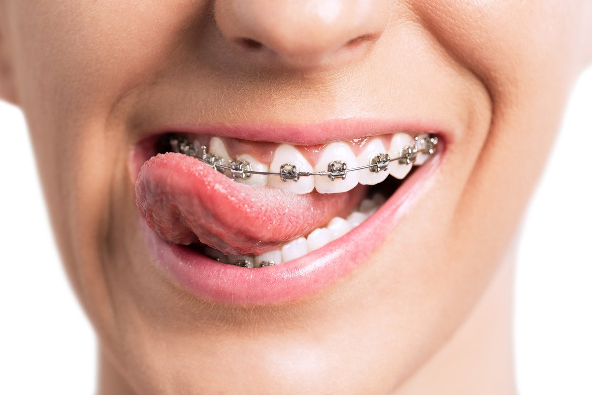braces Mckinney texas