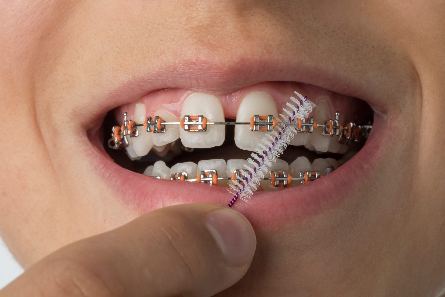 braces tips, tips for braces, oral hygiene