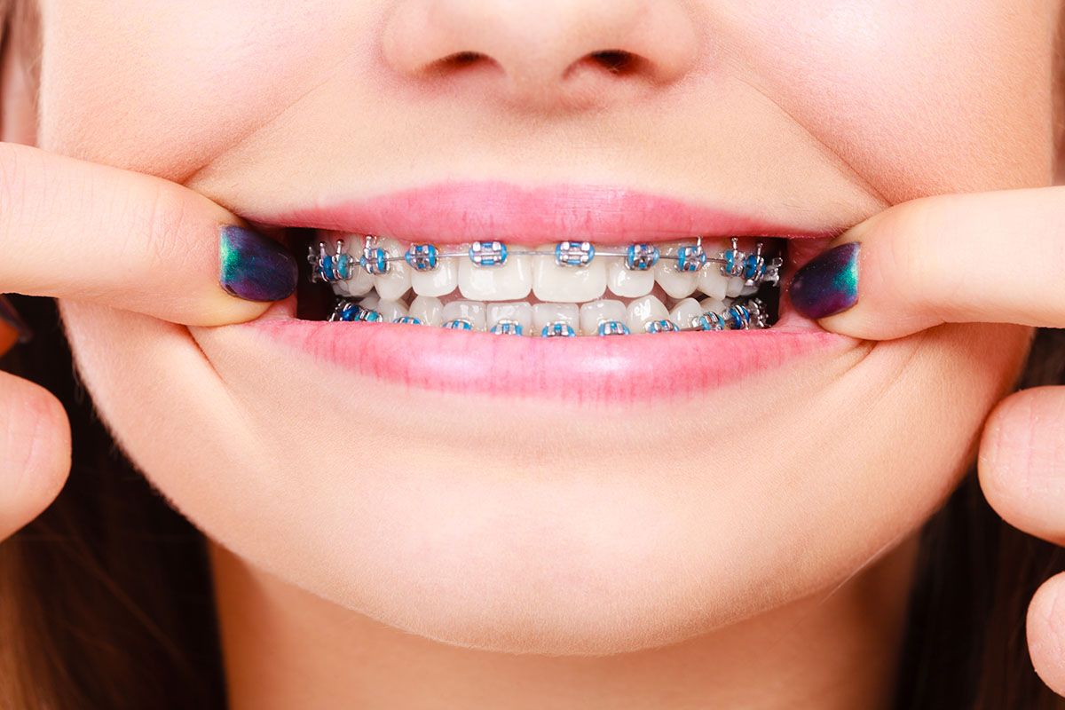 braces in McKinney